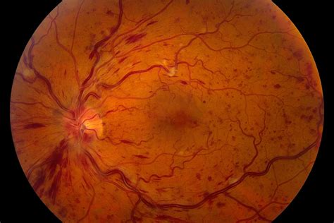 Chandra Observatory ਲਈ ਪ੍ਰਤੀਬਿੰਬ ਨਤੀਜਾ