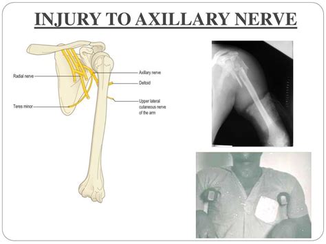 Axillary Nerve Dysfunction に対する画像結果