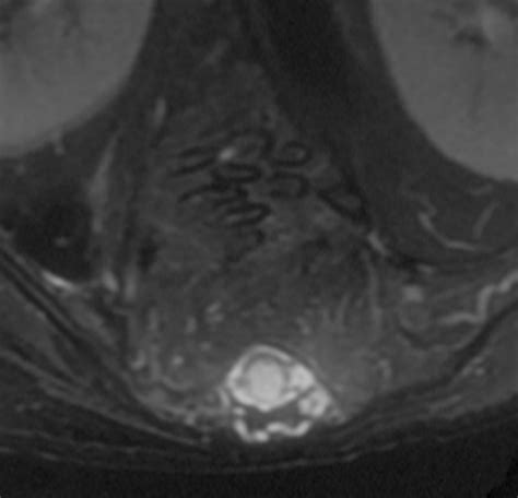 Afbeeldingsresultaten voor Angular Kyphosis TB Spine