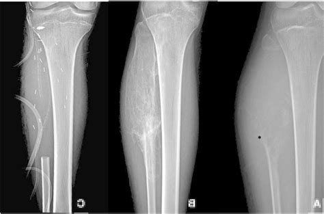 Image result for Codman's Lesion