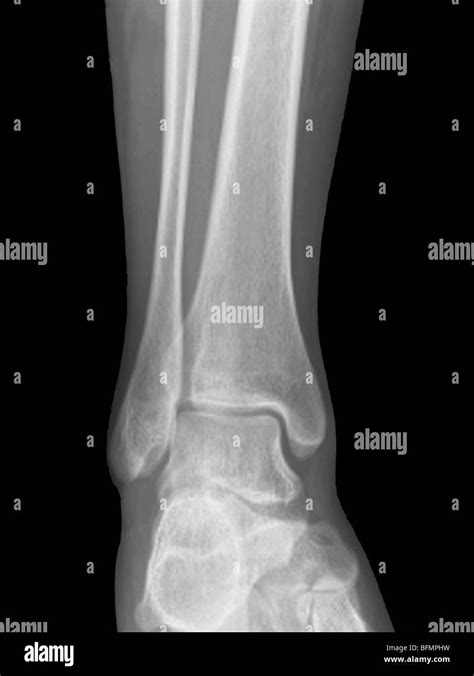 Image result for Normal Ankle Joint