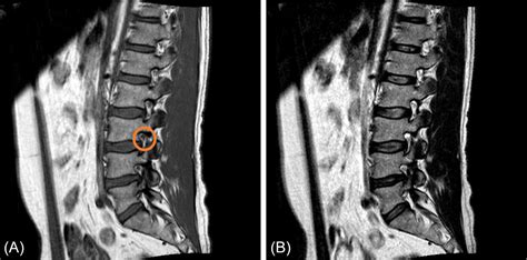 Abnormal MRI Lumbar Spine に対する画像結果