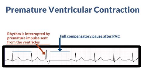 ECG PVC Examples に対する画像結果
