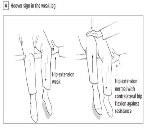 Image result for Leg. Sign Functional Movement Disorder