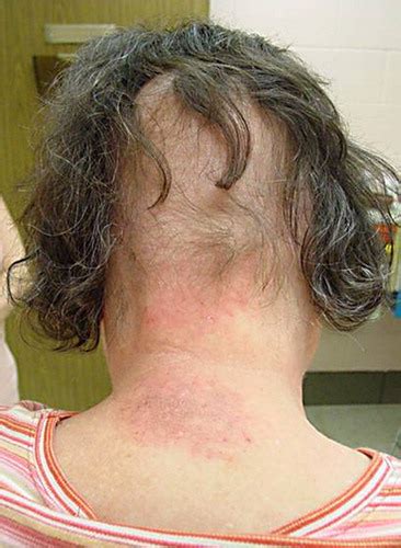 Fluroscopy Radiation Burn に対する画像結果