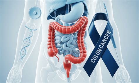 Image result for Subtle Signs of Colon Cancer