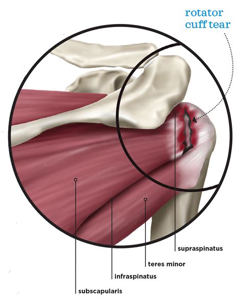Internal Rotation Shoulder Rotator Cuff に対する画像結果