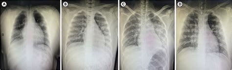 Pyrexia in PIV に対する画像結果