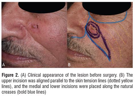 Toradh íomhá ar Sizes of Cutaneous Defect