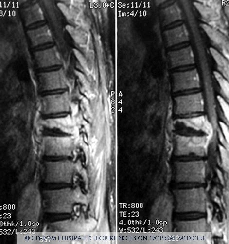 Afbeeldingsresultaten voor Angular Kyphosis TB Spine
