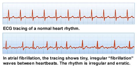 Image result for AFib Heart Rate Monitor