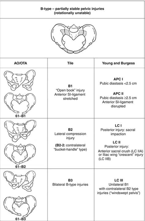 Afbeeldingsresultaten voor Pelvic Fracture Types