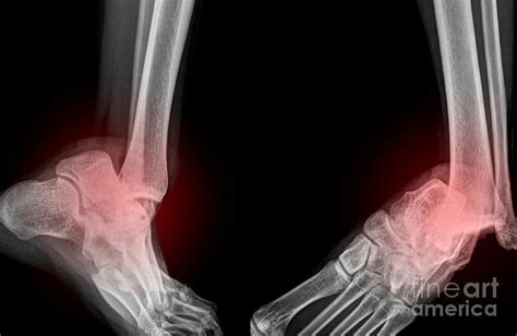 Image result for Dislocated Ankle