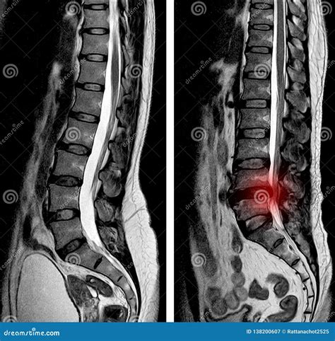Abnormal MRI Lumbar Spine に対する画像結果