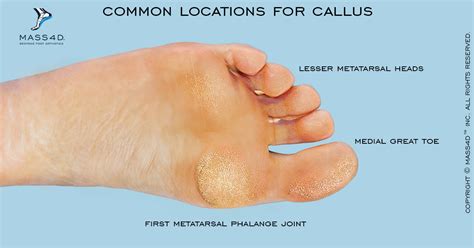 Image result for Toe Callus