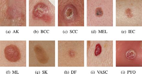 Toradh íomhá ar Types Skin Lesion Chart