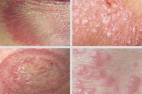 Image result for Red Rash On Private Area