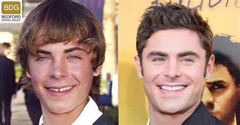 Simon Minter Teeth Before and After に対する画像結果