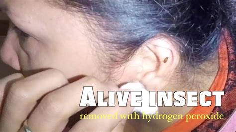 Toradh íomhá ar Bug Stuck in Ear