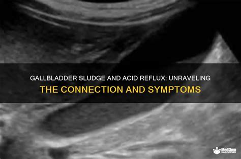 Image result for Sludge in My Gallbladder