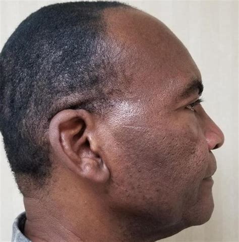 Image result for Scar On Right Side On Head