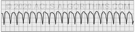 Image result for Pulseless VT ACLS Algorithm