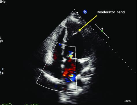Afbeeldingsresultaten voor Corrected Transposition