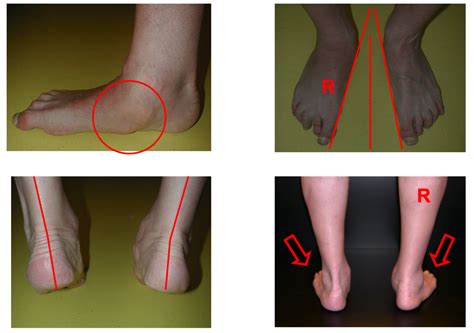 Image result for Pes Planovalgus