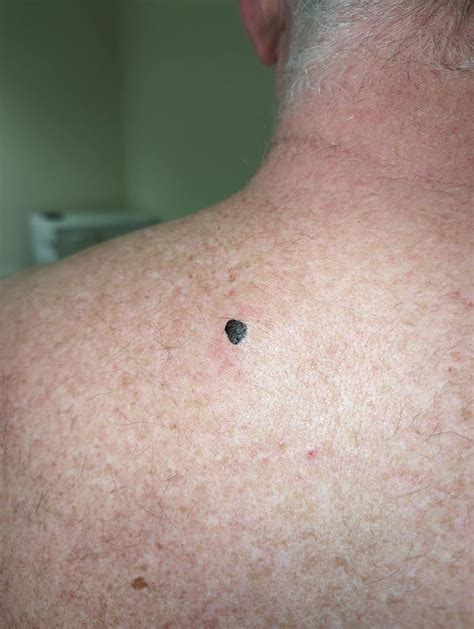 Image result for Sebaceous Cyst Pimple