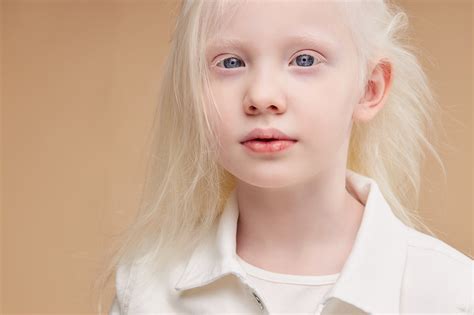 Light Blue Eyes Albinism に対する画像結果