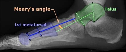 Résultat d’images pour Meary Angle Foot