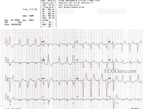 ECG PVC Examples に対する画像結果
