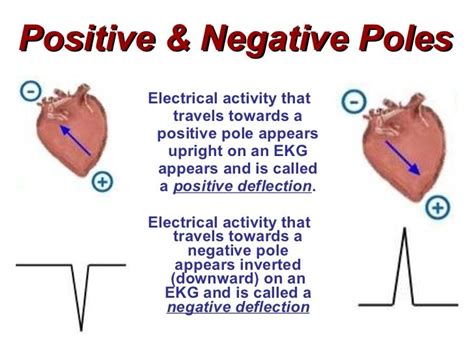 Image result for Positive Deflection ECG