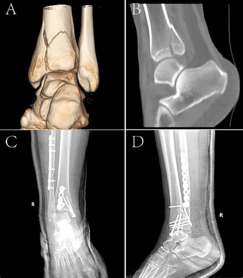 Ankle Posterolateral Approach に対する画像結果