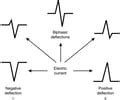 Image result for Positive and Negative Deflection ECG