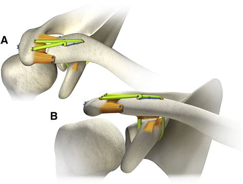 Toradh íomhá ar Endobutton Acromioclavicular Joint