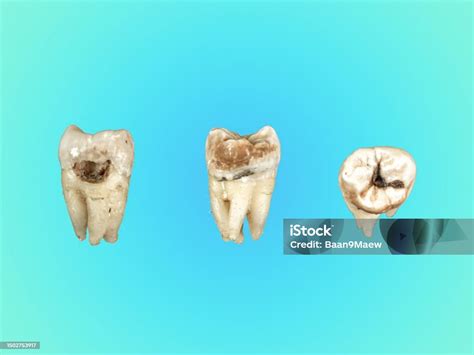 Image result for Broken Decayed Tooth