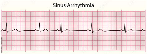Toradh íomhá ar Sinus Arrhythmia Rhythm