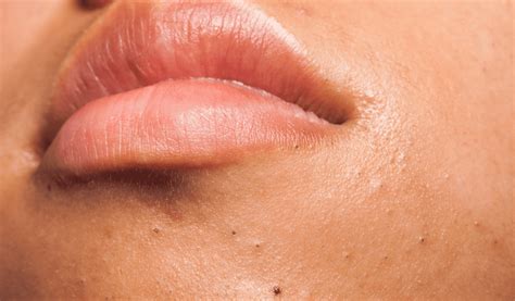 Image result for Closed Comedones Nose Nose