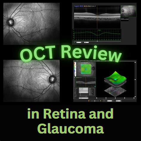 Image result for Oct Eye Scan Glaucoma