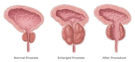 Prostate Cancer On Turp に対する画像結果