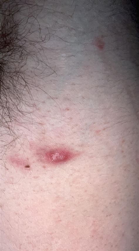 Image result for Painful Pimple Under Armpit