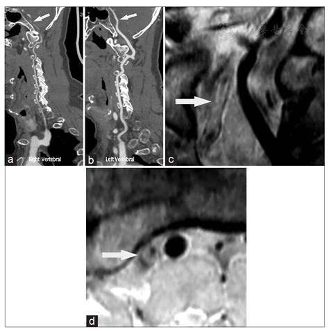 Hypoplastic Vertebral Artery に対する画像結果