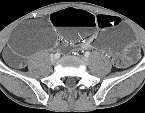 Image result for CT Enterography