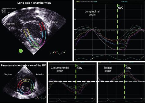 Toradh íomhá ar Speckle Tracking Algorithm