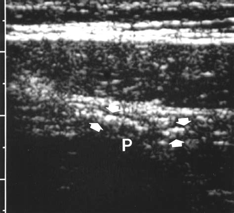 Image result for Compressed Ultrasound Procedure