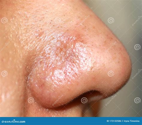 Image result for Sebaceous Cyst Pimple