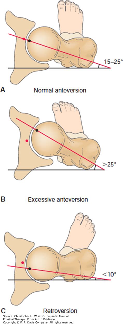 Toradh íomhá ar Femoral Anteversion vs Retroversion
