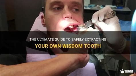 Toradh íomhá ar Extracting a Wisdom Tooth