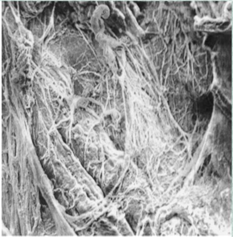 Image result for Muscle Scar Tissue Fascia